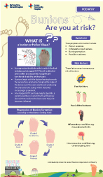 Bunions - Are You at Risk?